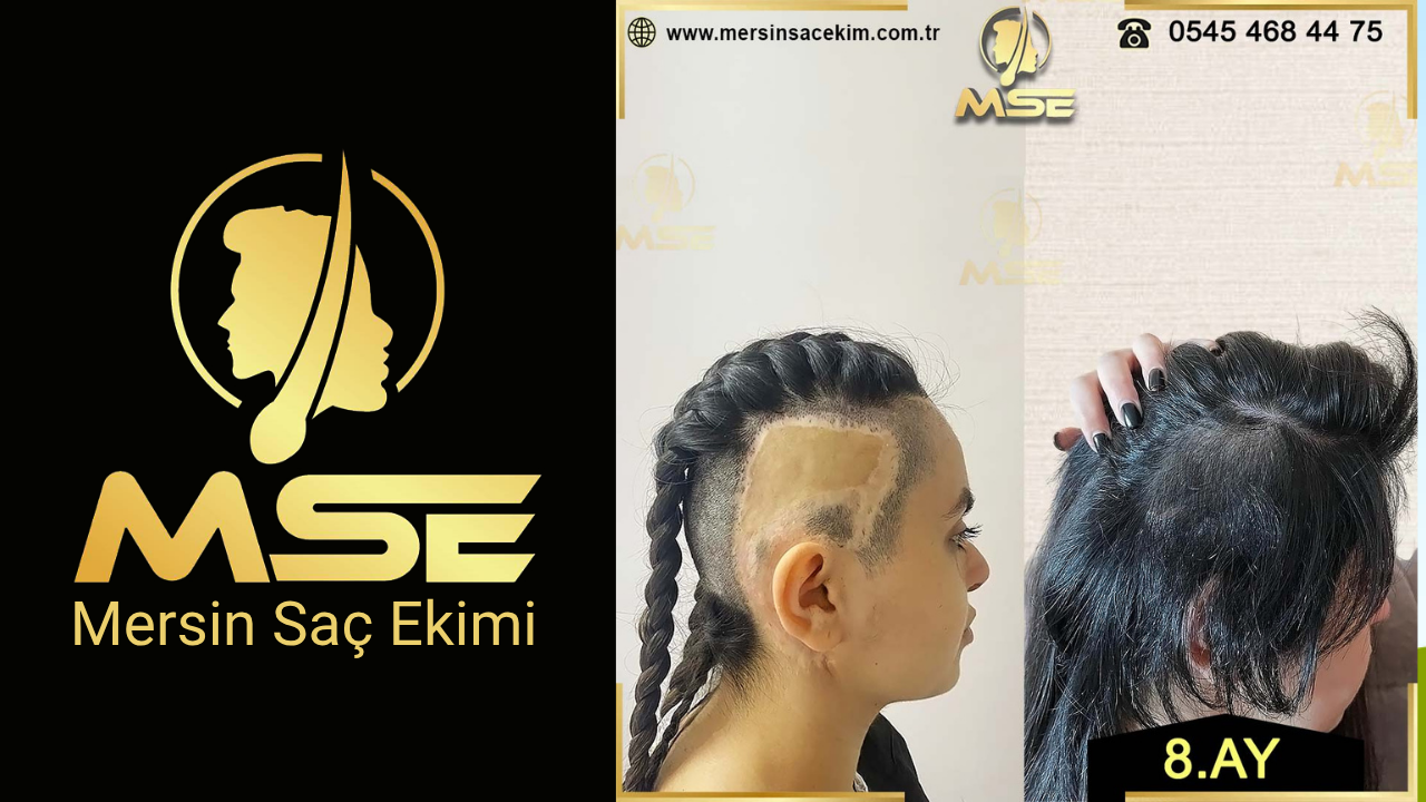 MERSİN SAÇ EKİMİ